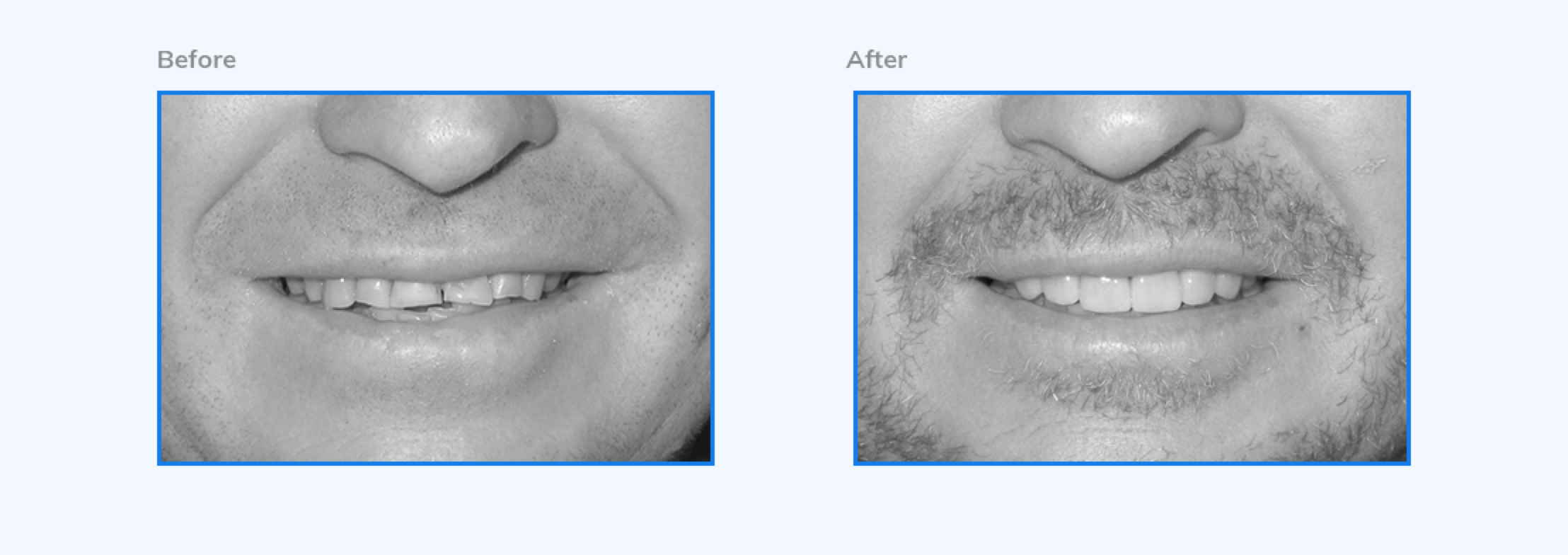 Galería dental - Rejuvenecimiento de encías